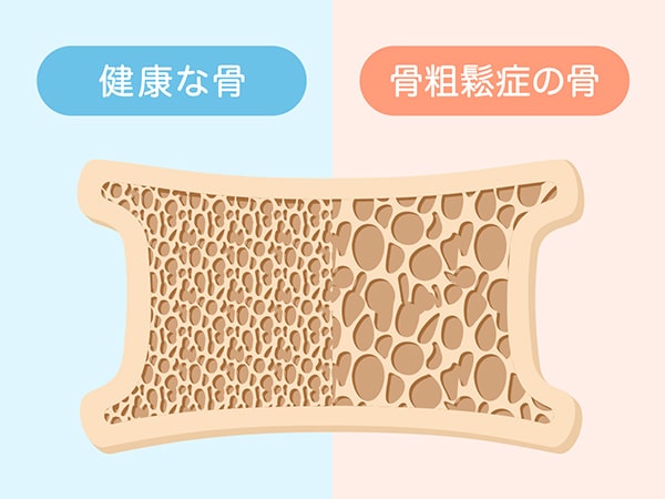 骨粗しょう症外来